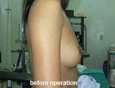 plastic-surgery-breast-augmentation 